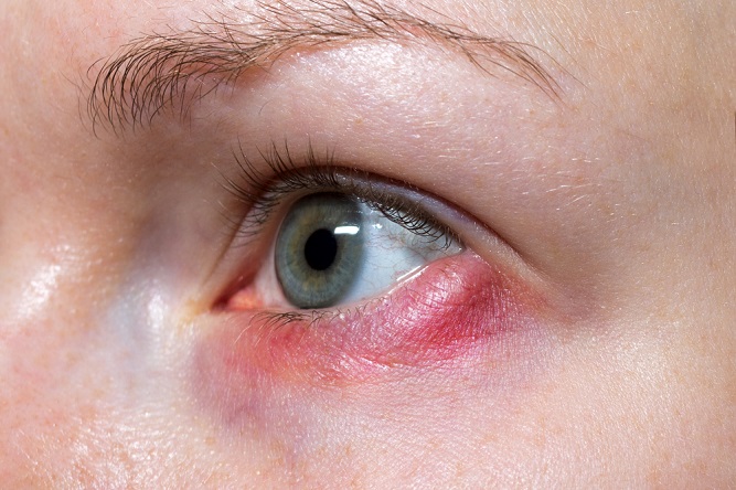 sore-eyes-symptoms-causes-cures